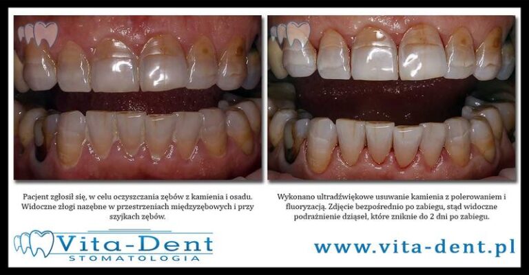 Skuteczne metody na usunięcie kamienia z prysznica, kabiny wanny, baterii i płytek