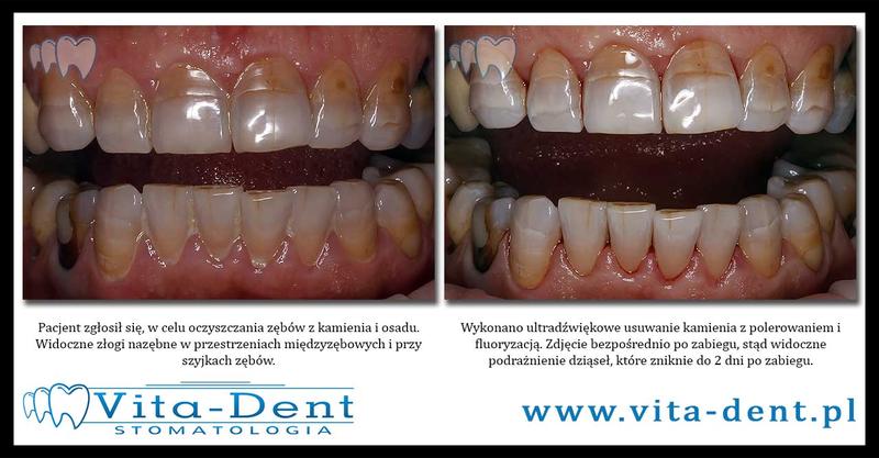 Skuteczne metody na usunięcie kamienia z prysznica, kabiny wanny, baterii i płytek